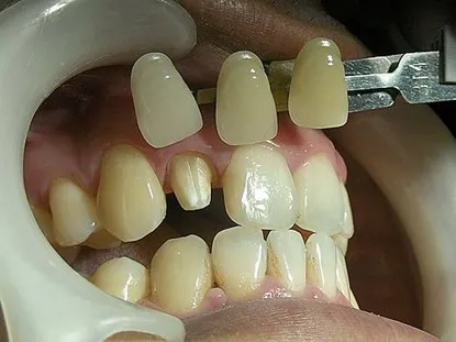 渥爾牙醫診所：Cap-Lock全瓷牙冠安裝，回診、追蹤！