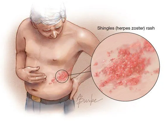 https://i1.wp.com/jeffreydachmd.com/wp-content/uploads/2015/06/shingles_photo.jpg?ssl=1