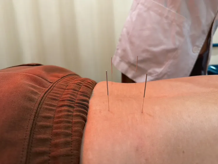 紅外線熱敷能促進局部血液循環，加強針灸後的放鬆效果。