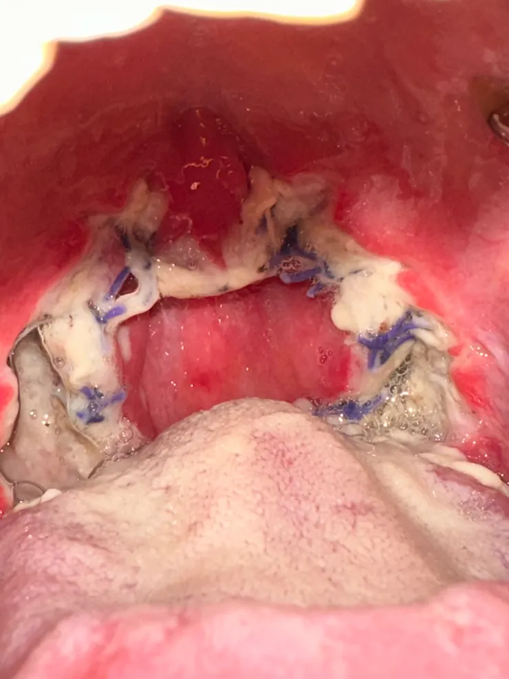 傷口會變成白色 再推掉