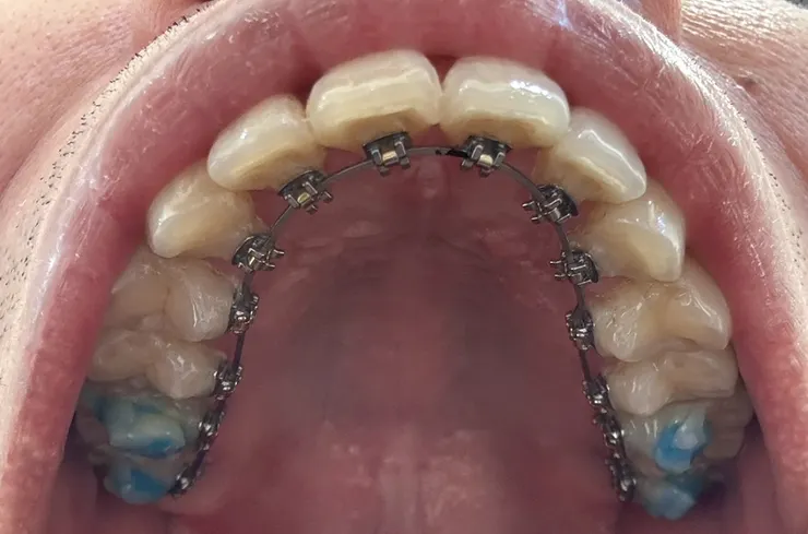 樂心牙醫：舌側矯正的專科診所，要做舌側矯正交給陳政偉醫師！