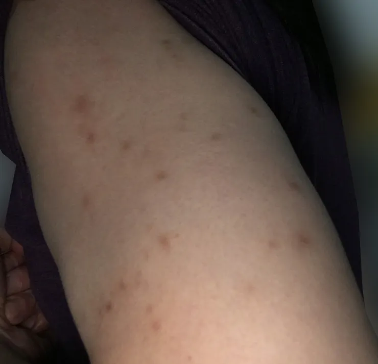 床蝨的咬痕特色：成群或連線，常見於大小腿、手臂、手背