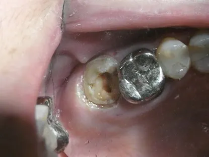 渥爾牙醫診所:蛀蝕深入牙肉下的修復挑戰!Cap-Lock全瓷系列拯救上顎第二大臼齒!