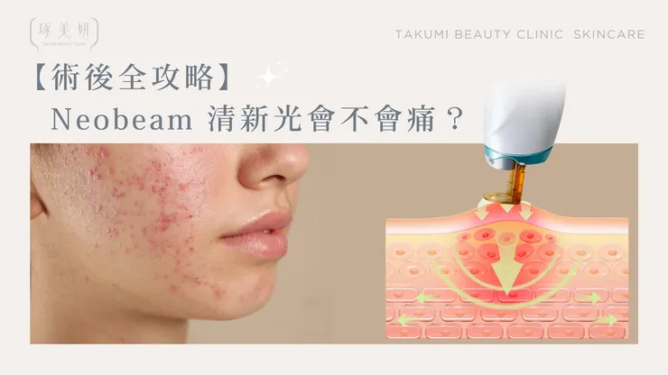 【術後全攻略】Neobeam 清新光會痛嗎？有沒有修復期？一篇文章幫你解惑