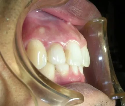 渥爾牙醫診所：Cap-Lock全瓷牙冠安裝，回診、追蹤！