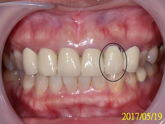 原來連在一起的假牙，以修飾成人牙齦萎縮的問題，下詳內文另外也請注意6顆假牙邊緣的牙齦，全都有程度不一的暗紫紅色慢性發炎，尤其瓷裂處，看下圖拆完假牙的圖，才知造成發炎的真相，難怪病人說有時刷牙會流血
