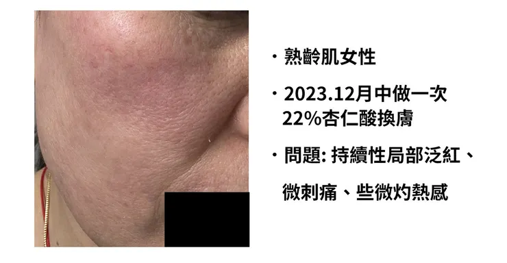 敏感肌怎麼洗臉？