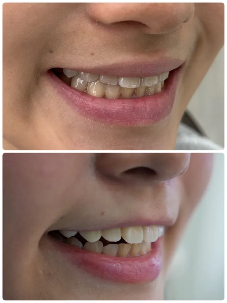 渥爾牙醫診所：大安區美學新標竿！渥爾牙醫4.0團隊，頂級美白牙齒貼片，打造完美笑容！