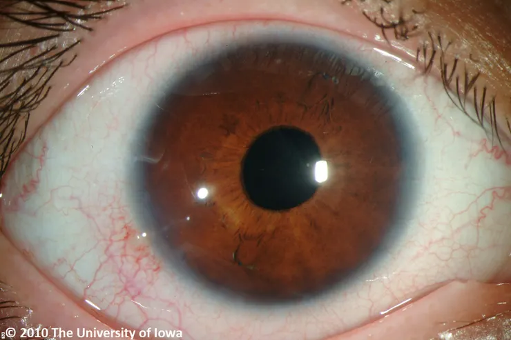 Marfan syndrome—eye rounds
