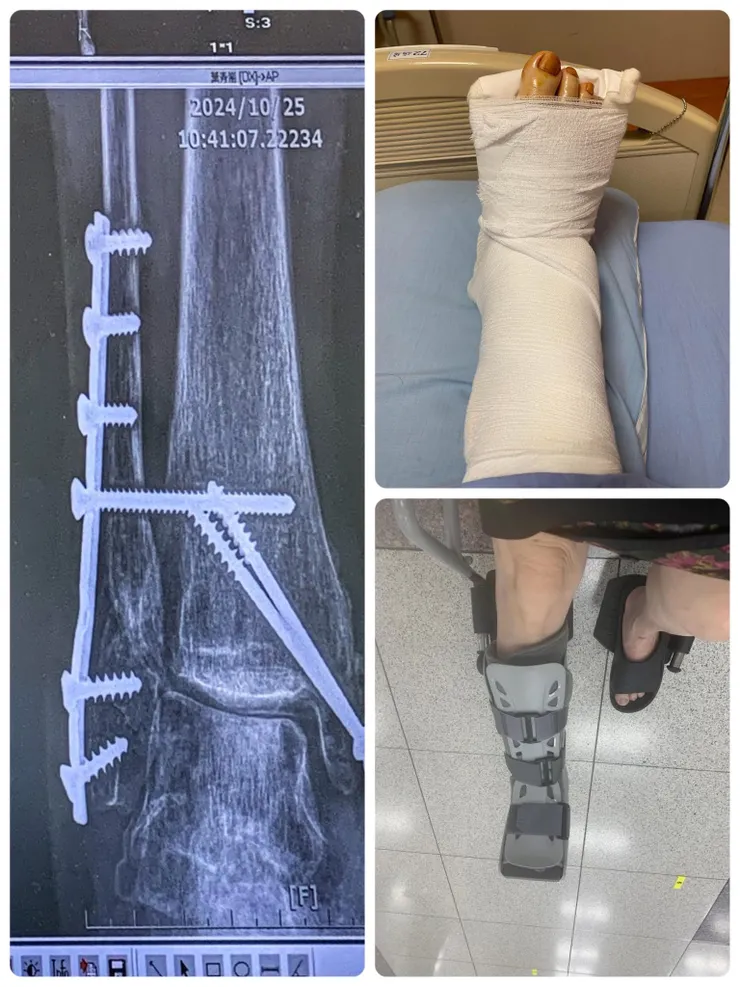 左邊是已經打上一支鋼片和兩隻鋼釘的X光片。右上是2024年7月30日經過5個半小時手術被推進病房時。右下是術後2024年9月26日試穿護具鞋。