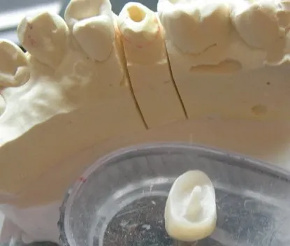 渥爾牙醫診所：小臼齒裂牙不拔牙，Cap-Lock全瓷修復保住原牙！