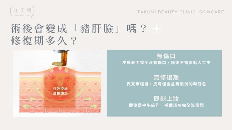 【術後全攻略】Neobeam 清新光會痛嗎？有沒有修復期？一篇文章幫你解惑