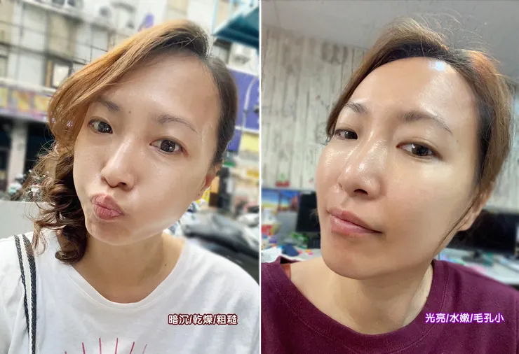 台北打皮秒│探索皮秒+蜂巢(超級鏡片ReFIX)-台北醫美診所推薦