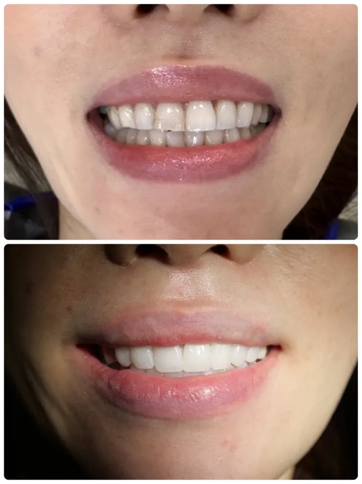 笑容重啟的關鍵！「明眸鋯齒」美白貼片，16顆齒列改造打造專屬你的自信微笑！