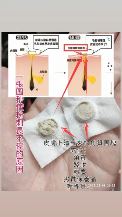 為什麼八合一角質管理可以讓粉刺停止反覆堆積?