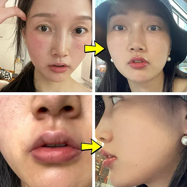 脂漏性皮膚炎前後對比