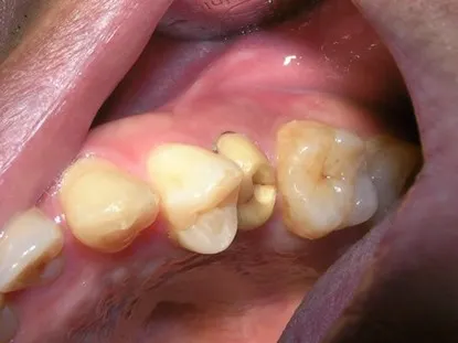 渥爾牙醫診所：小臼齒裂牙不拔牙，Cap-Lock全瓷修復保住原牙！