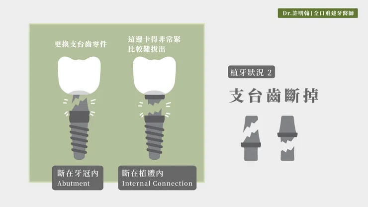 第2種植牙狀況 支台齒斷掉