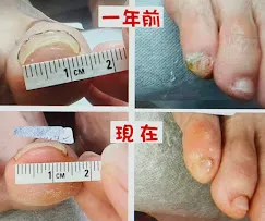 ⚠️ 溫馨提醒： 本服務採物理性修護，非醫療行為，不具備任何療效。 指甲狀況因人而異，建議現場諮詢評估。 有傷口或化膿者請先看醫生喔！ 