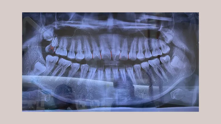 醫生講解說明，會先透過牙套拉開牙齒距離，最後在畫紅線的幾顆牙齒進行細微的修磨，照片左上方畫叉叉的是之前根管治療的牙齒，因為已經沒有用處，後面在矯正期間會安排拔除