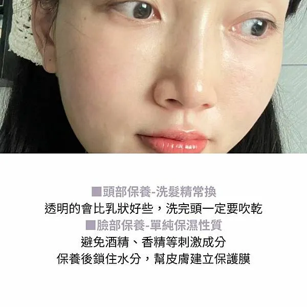 脂漏性皮膚炎頭皮屑