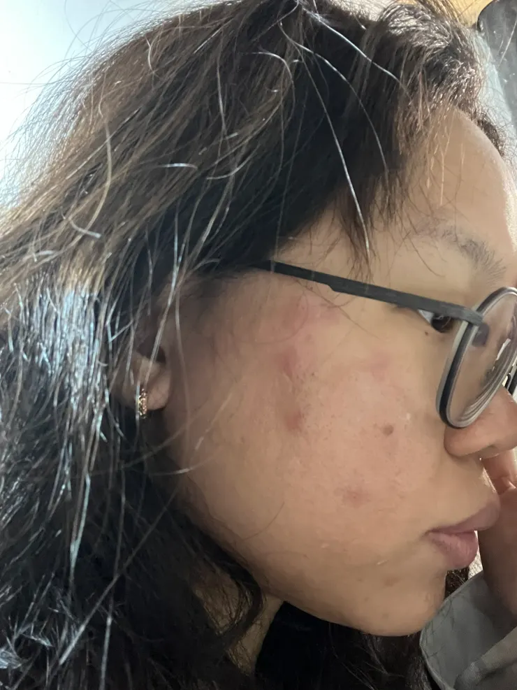 臉整個起疹子