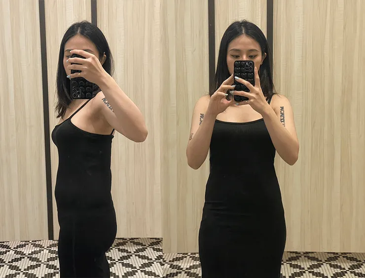 抽脂補胸前的梨形身材