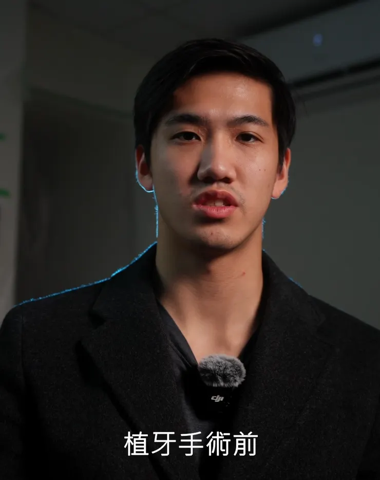 植牙懶人包】植牙流程有哪些？專業醫師拆解兩大關鍵階段，缺牙族必看！