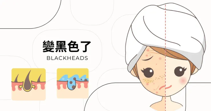 清粉刺/除粉刺/黑頭粉刺
