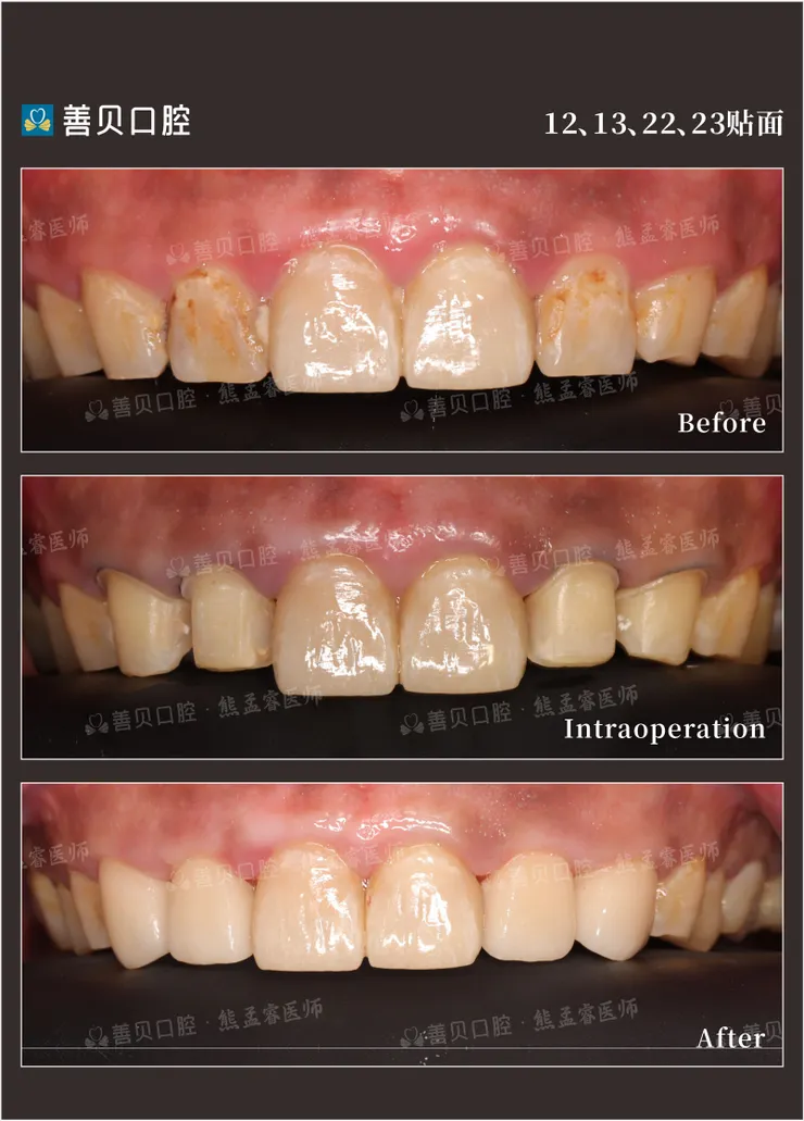 深圳牙齒美容貼片善貝口腔