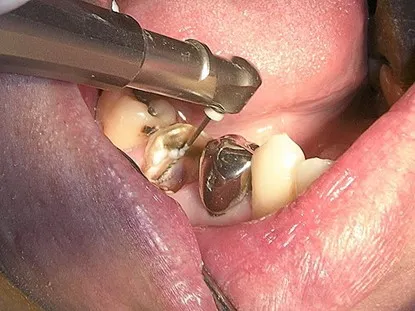 渥爾牙醫診所: Cap-Lock全瓷系列修復案例!斜裂下大臼齒的成功修復!