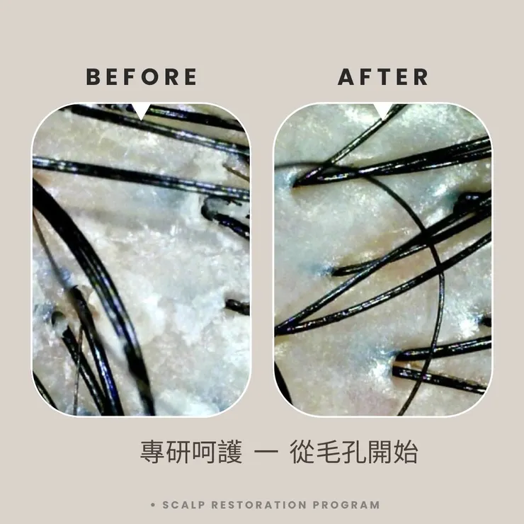 非醫療聲明： 「本所提供的頭皮管理與育髮調理服務，旨在改善頭皮環境、強健毛囊，非植髮手術，亦非藥物治療。對於雄性禿或嚴重病理性落髮，仍建議諮詢專業醫師意見。」