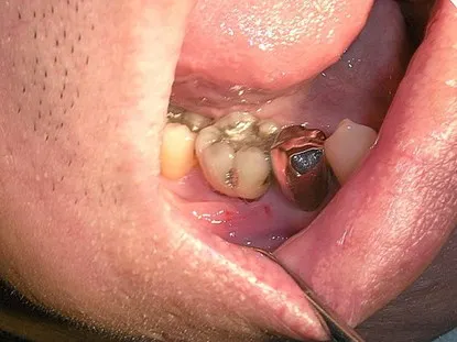 渥爾牙醫診所: Cap-Lock全瓷系列修復案例!斜裂下大臼齒的成功修復!