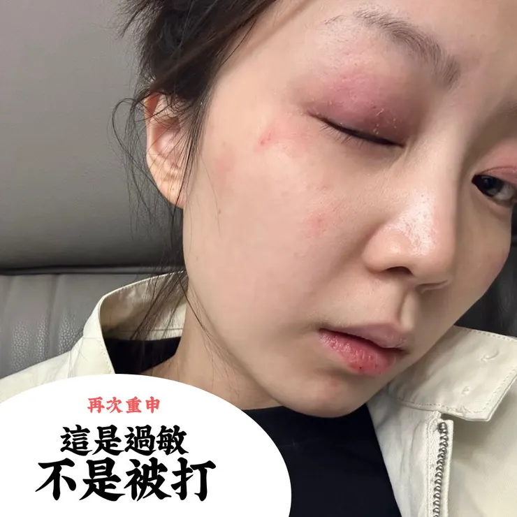 肌膚過敏紅腫怎麼辦