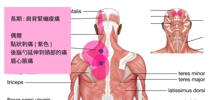 長期的肩頸痠痛與眉心脹痛問題 🥲