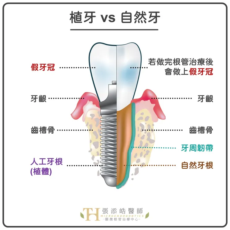 植牙 vs 顯微根管治療：價格、效果、成功率比較