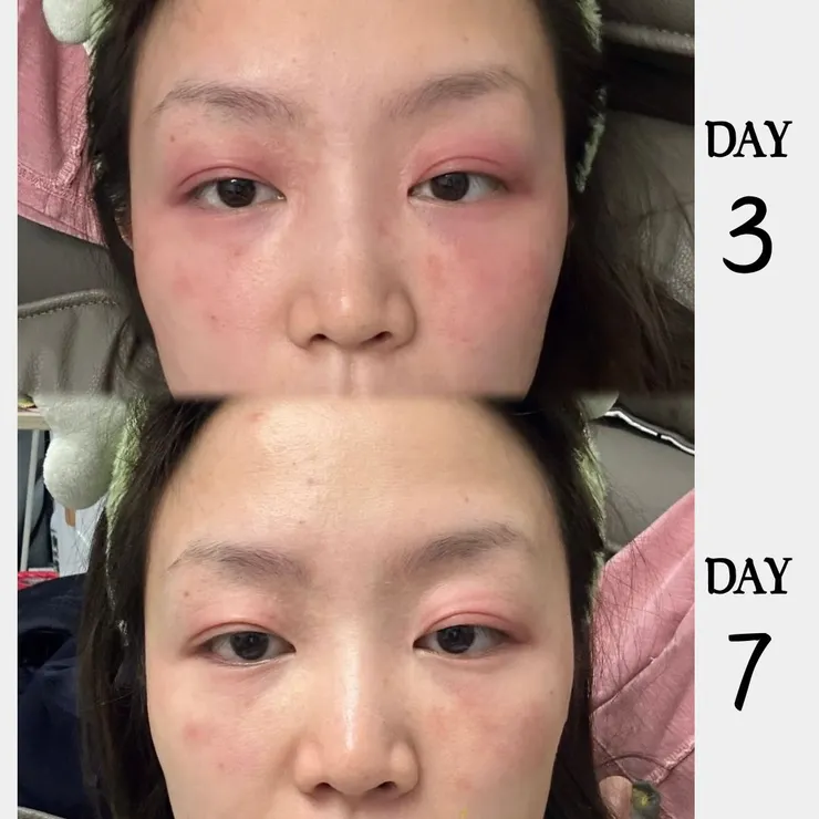 肌膚過敏前後對比