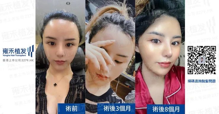 植髮效果