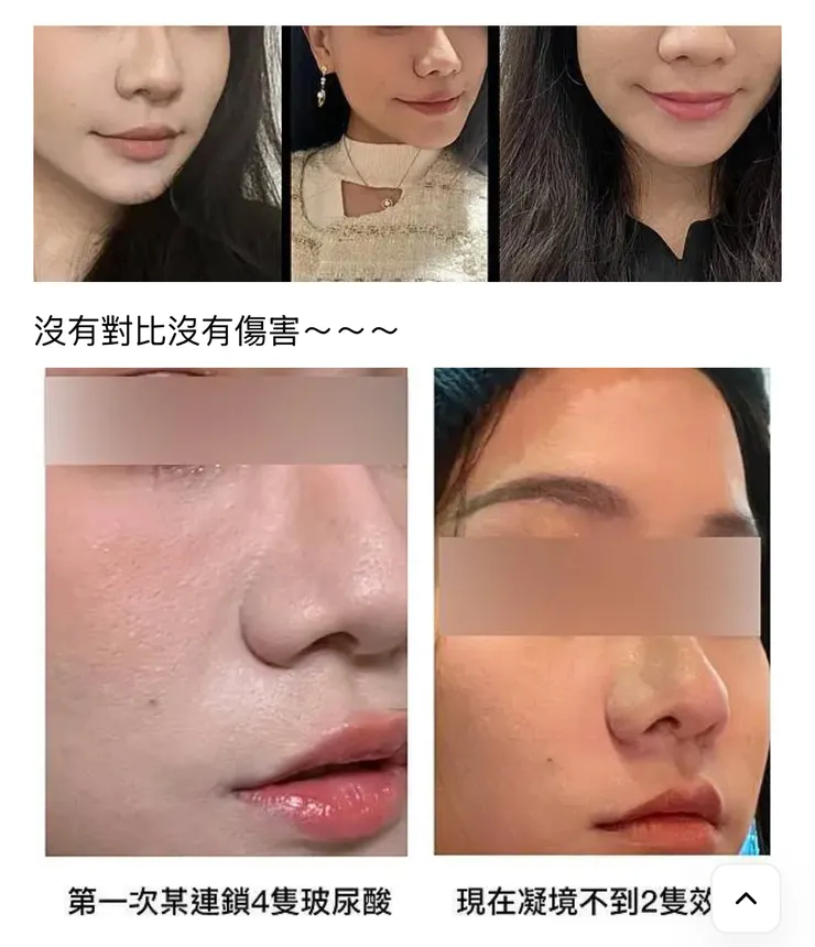 凝境玻尿酸對比