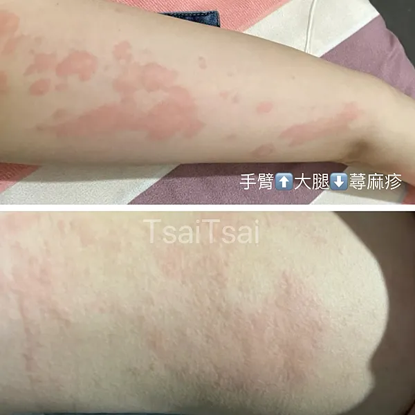 皮膚過敏蕁麻疹