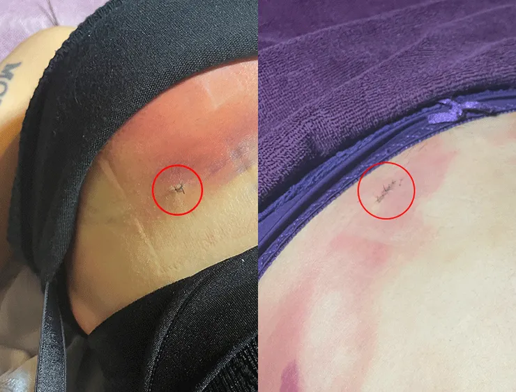 抽脂傷口約0.5~0.8mm