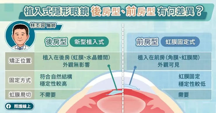 植入式隱形眼鏡後房型、前房型有何差異