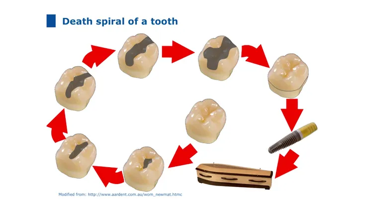 傳統治療蛀牙下的牙齒的一生，這張更清楚了