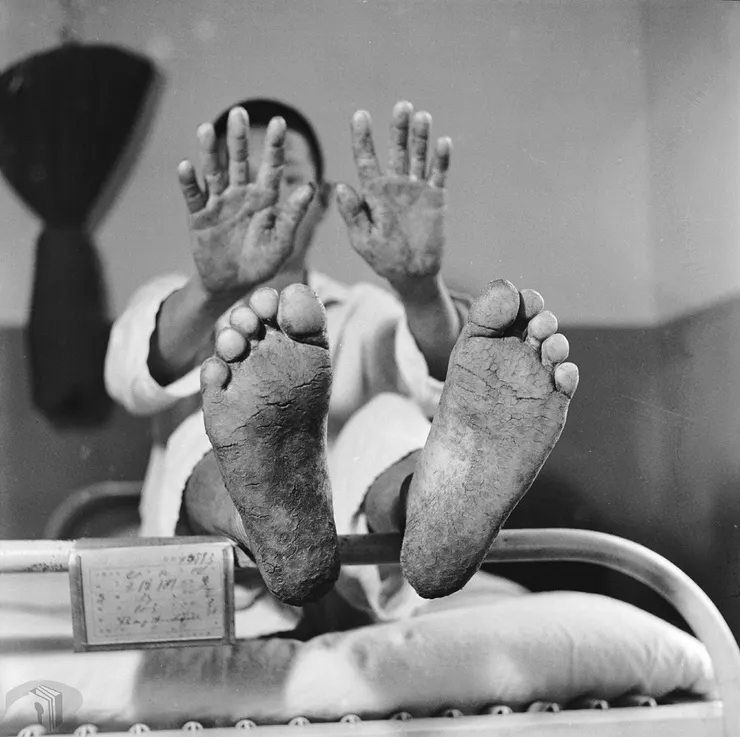 圖2 烏腳病患者手腳特寫 案名：1952-1954農復會專輯 檔號：0041/0001/1 來源機關：行政院新聞局 管有機關：國家發展委員會檔案管理局