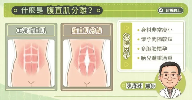 什麼是腹直肌分離