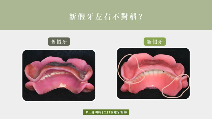 新的全口活動假牙左右不對稱?