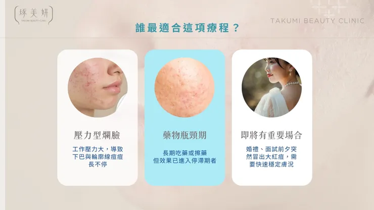 告別反覆長痘！Neobeam 清新光為何是「成年痘、壓力痘」的終結者？