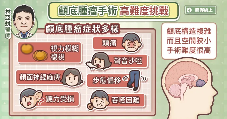 顱底腫瘤手術高難度挑戰