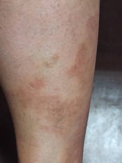 濕疹治療-算第三週