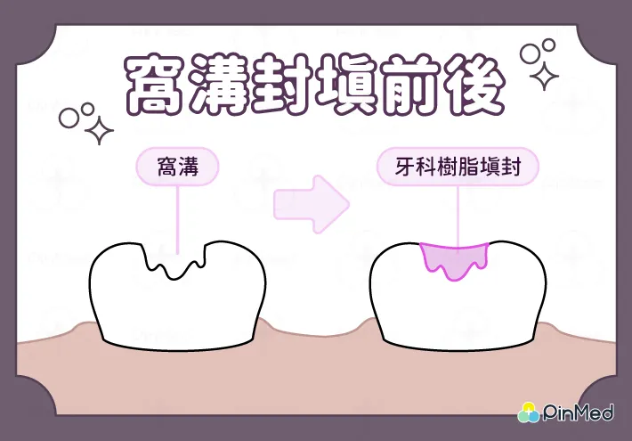 窩溝封填前後差異